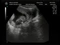 3D/4D Ultrasound at 15 weeks Video!!