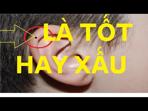 xem bói nốt ruồi ở tai đàn ông LÀ TỐT HAY XẤU là phúc hay họa cùng xem