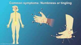 Multiple Sclerosis Signs, Symptoms And Treatments