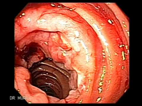 stage 4 stomach cancer chemo treatments