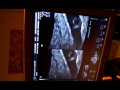 5.6 weeks ultrasound.