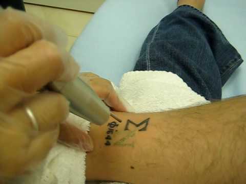 Is tattoo removal by laser painful? What is the cost of laser tattoo removal