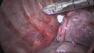 Use of Enseal Tissue Sealer for Pulmonary Right Lower Lobectomy