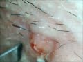 zit