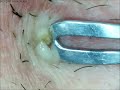 zit