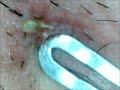 zit