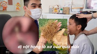 Hóc Xơ Dừa Bs Lại Minh Tuấn