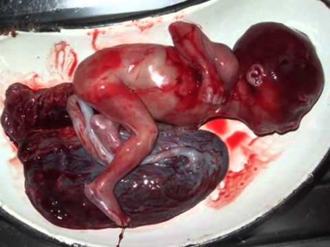 how to abort pregnancy before missed period