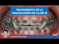 Tratamiento de la maloclusión de clase III