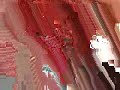 dental Implant Standard Plus Implant surgery straumann