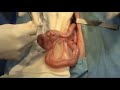 Anastomosis