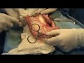Anastomosis