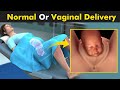 Normal Vaginal Childbirth - How Baby Is Delivered Form Female Body?