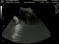 Mattie's 3D Ultrasound Nov 18 2010