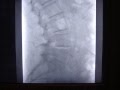 DISCOLISIS LUMBAR EN CANAL LUMBAR ESTRECHO.MP4