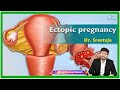 Ectopic Pregnancy : Etiology, Clinical features, Diagnosis, Treatment and Complications : Gynecology