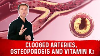 Clogged Arteries, Osteoporosis and Vitamin K2 - Dr. Eric Berg DC