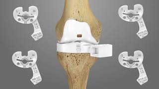 iTotal PS Knee Replacement Surgical Technique Animation | Conformis