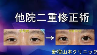 ☆二重修正☆ パッチリ二重に修正する!!