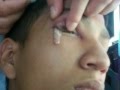 FORUNCULO EN UN OJO