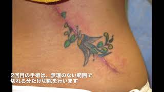 腰の刺青分割切除 山本クリニック