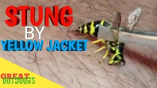 Stung by a Yellow jacket.