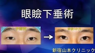 眼瞼下垂術 山本クリニック