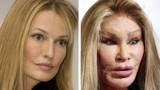 10 Worst Cases Of Plastic Surgery Gone Wrong