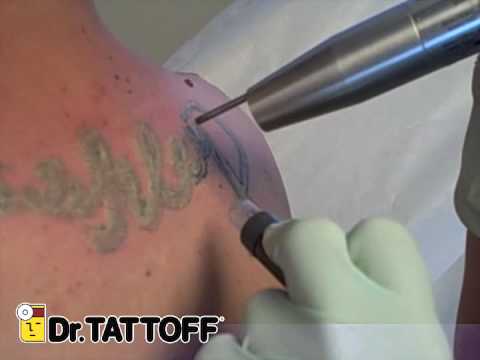 Tattoo Removal - Upper Back Name Tattoo. Oct 16, 2009 9:26 AM