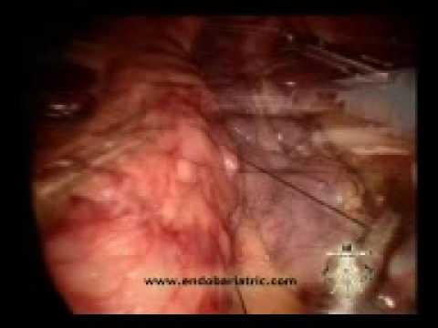 Gastric Sleeve (VSG)