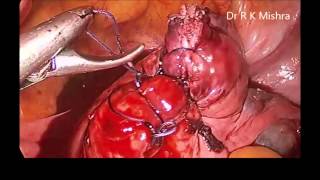 Dr Mishra's Lecture on Laparoscopic Myomectomy