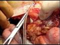 Colon Surgery