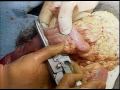 Colon Surgery