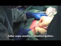Advances in Breast Cancer Surgery - The decisive Role of Intra-Operative Ultrasound