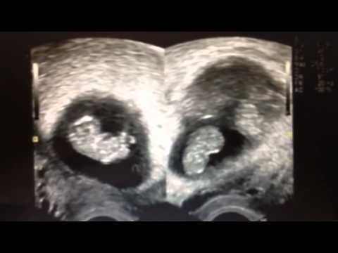 Triplets baby ultrasound at 9 weeks - YouTube