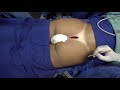 Gluteoplastia com implantes / Gluteal augmentation with implants.