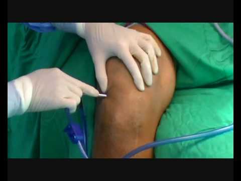 arthroscopic debridement surgery India, arthroscopic debridement surgery, India arthroscopic debridement surgery, arthroscopic debridement knee surgery, arthroscopic debridement knee surgery India, arthroscopic debridement surgery hospitals India, arthroscopic debridement surgery orthopedic surgeons India, arthroscopic debridement surgery medical consultants India, affordable arthroscopic debridement surgery India