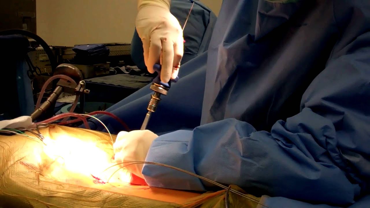 Minimally invasive tubular surgery for transforaminal lumbar interbody
