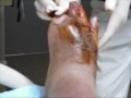 Dr. Robert Testa removing gauze for the 1st time since amputation of 4th toe--06-16-2010..wmv