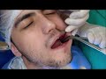 20 lik diş çekimi , 20lik diş ameliyatı , implant kemik nakli