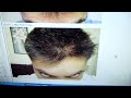 TREATMENTS FOR BALDNESS TREATMENTS FOR BALDNESS