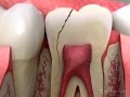 Dentist - Cracked Tooth Crown Procedure