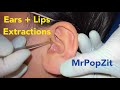 Acne Extractions! Large Blackheads and whiteheads in the ears and on the lips. MrPopZit