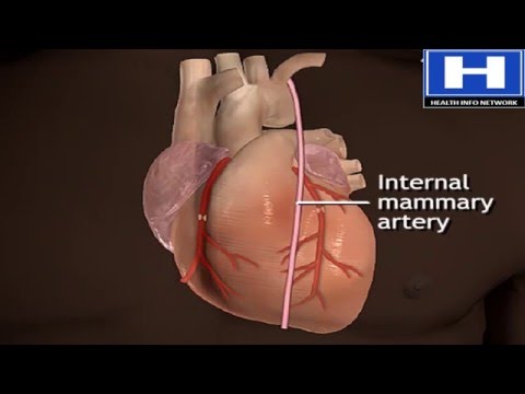Cardiac Bypass Surgery And Viagra