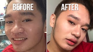 My Nose Lift Experience (ft. Prettylooks)