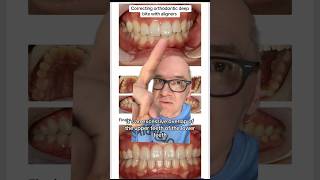 Correcting Deep Bite With Orthodontic Aligners