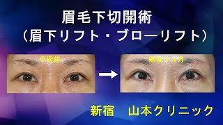 眉毛と目の距離が縮まり若々しい目元に【山本クリニック】
