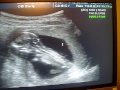 12 Week Live Ultrasound: Baby Harris