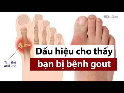 Dấu hiệu nhận biết mình bị bệnh gout PLO