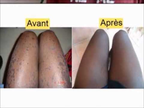 Lhuile chi pour la personne des boutons